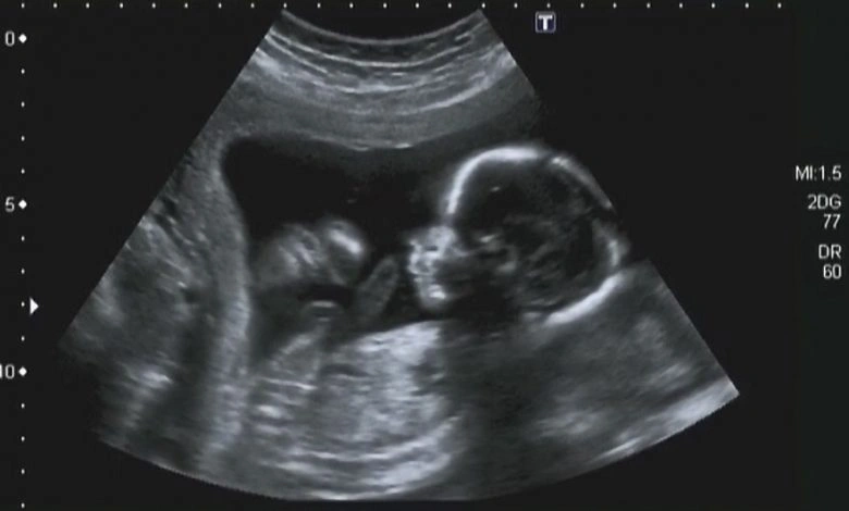 آیا تشخیص اوتیسم در قبل یا بدو تولد ممکن است؟