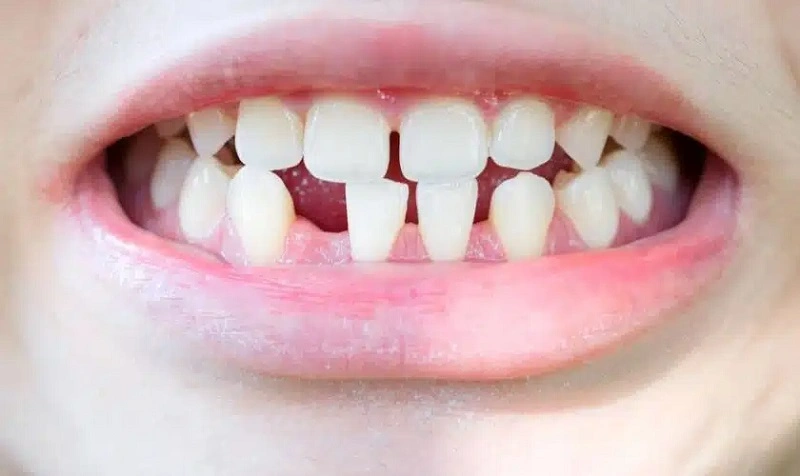بررسی چگونگی تشخیص اوتیسم از روی دندان