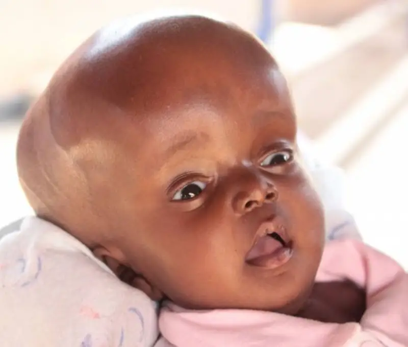  کاردرمانی کودکان هیدروسفالی چیست؟