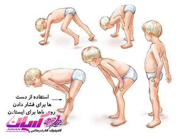 کاردرمانی برای کودکان دارای ضعف عضلانی