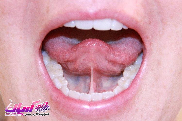 روش ها و تمرین گفتاردرمانی لکنت